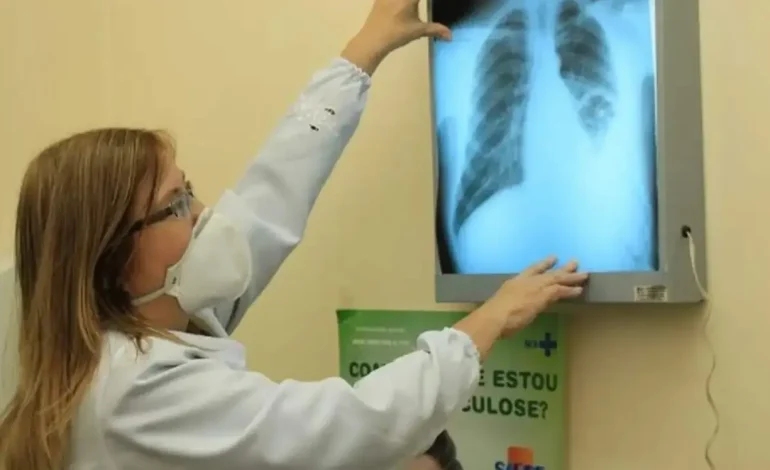 Tuberculose no Brasil: um desafio ainda vivo