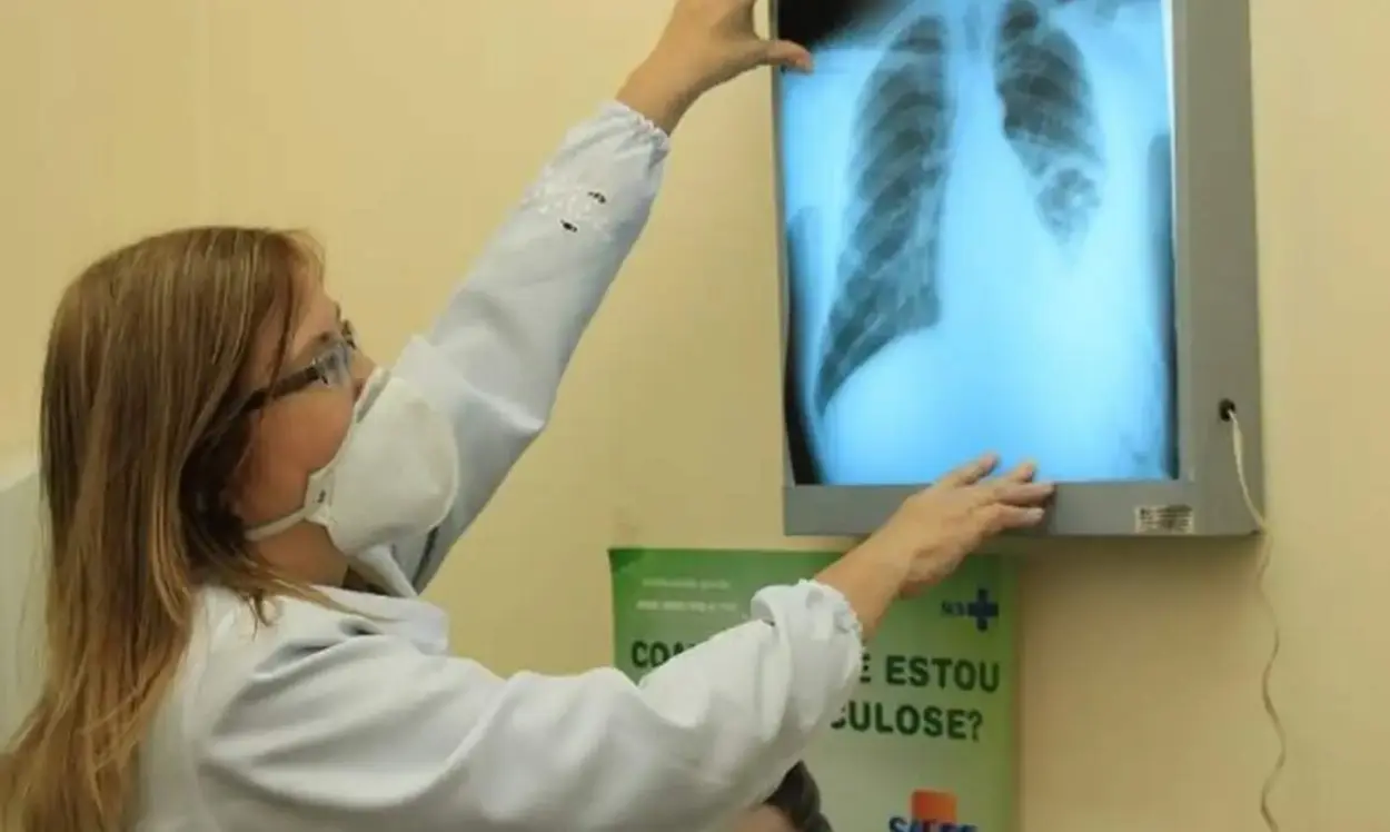 Tuberculose no Brasil: um desafio ainda vivo