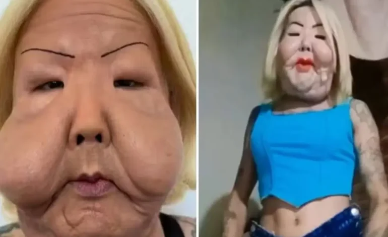 Juju do Pix: Influenciadora mostra recuperação facial após cirurgia de remoção de óleo mineral