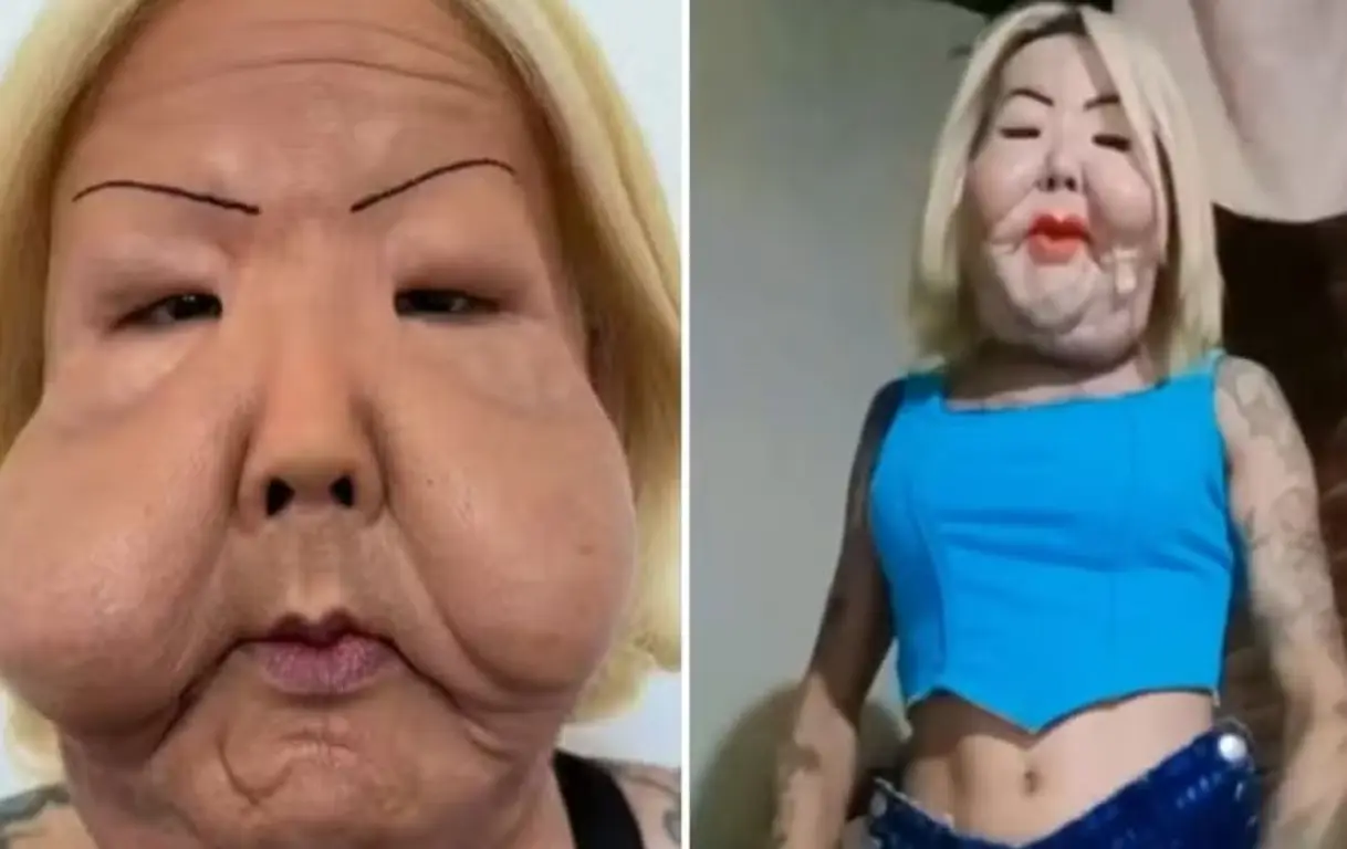 Juju do Pix: Influenciadora mostra recuperação facial após cirurgia de remoção de óleo mineral